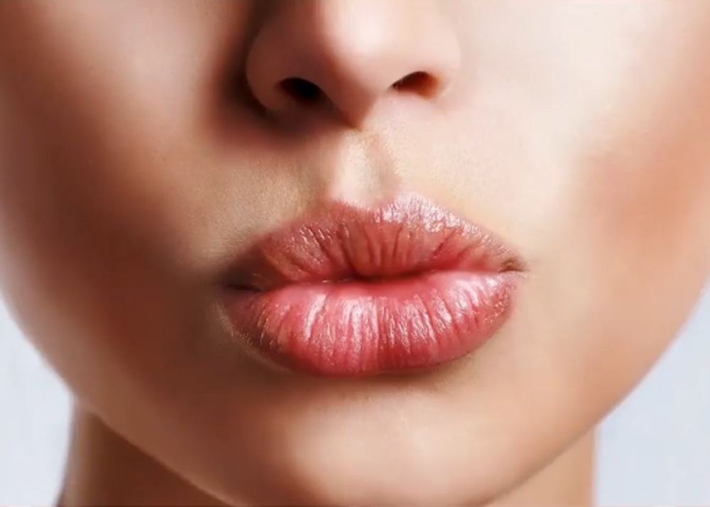 Lippenaufbau durch Lippenunterspritzungen mit hochwertigem Hyaluron